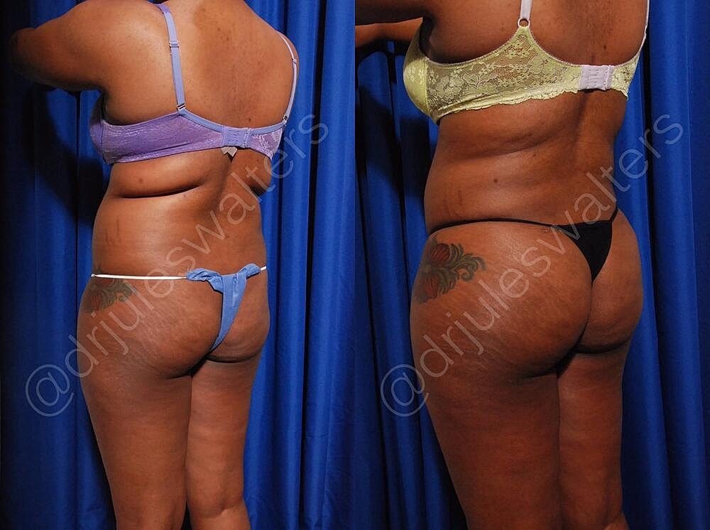 Liposuction Before & After