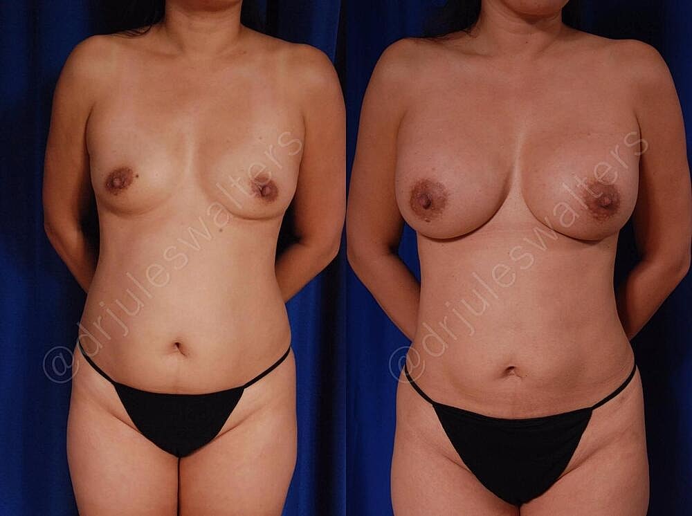 Liposuction Before & After