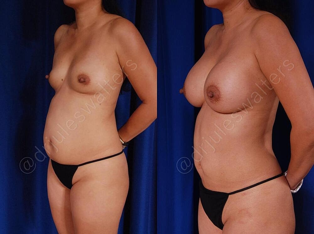 Liposuction Before & After