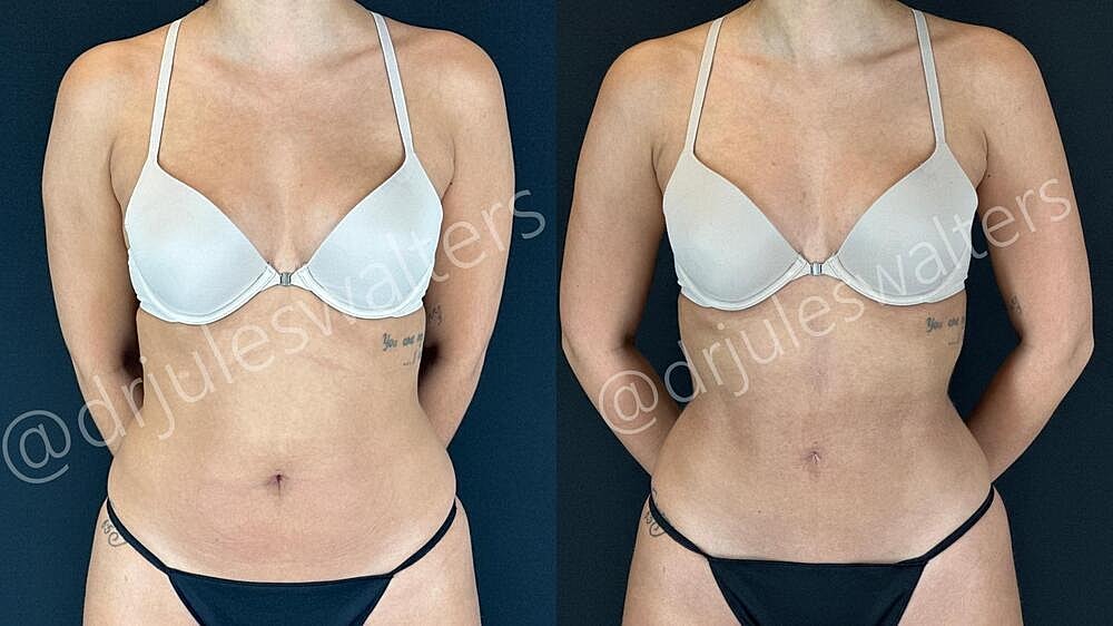 Liposuction Before & After