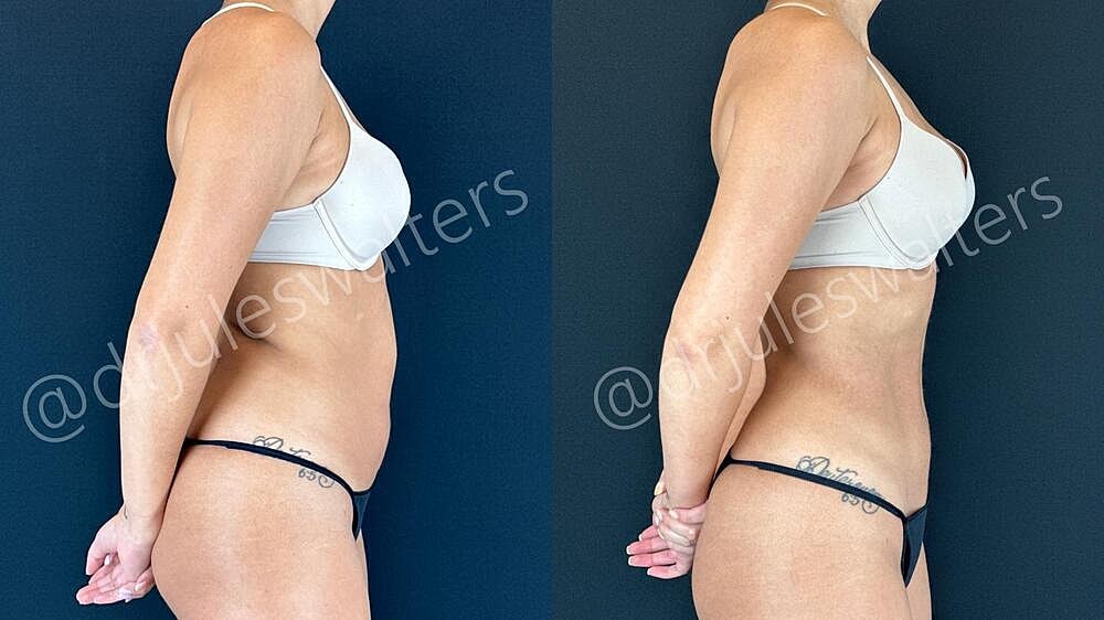 Liposuction Before & After