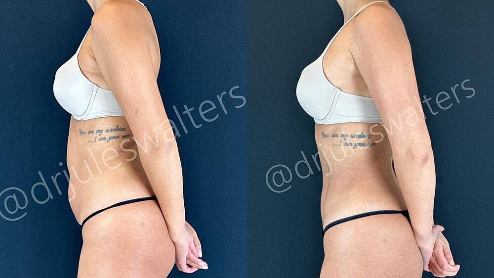 Liposuction Before & After