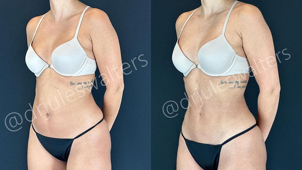 Liposuction Before & After