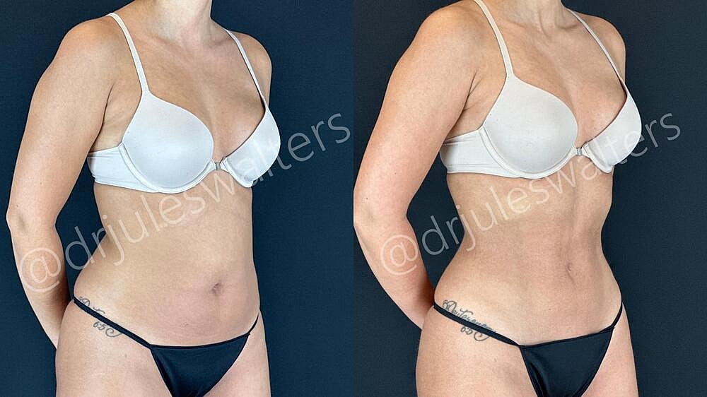 Liposuction Before & After
