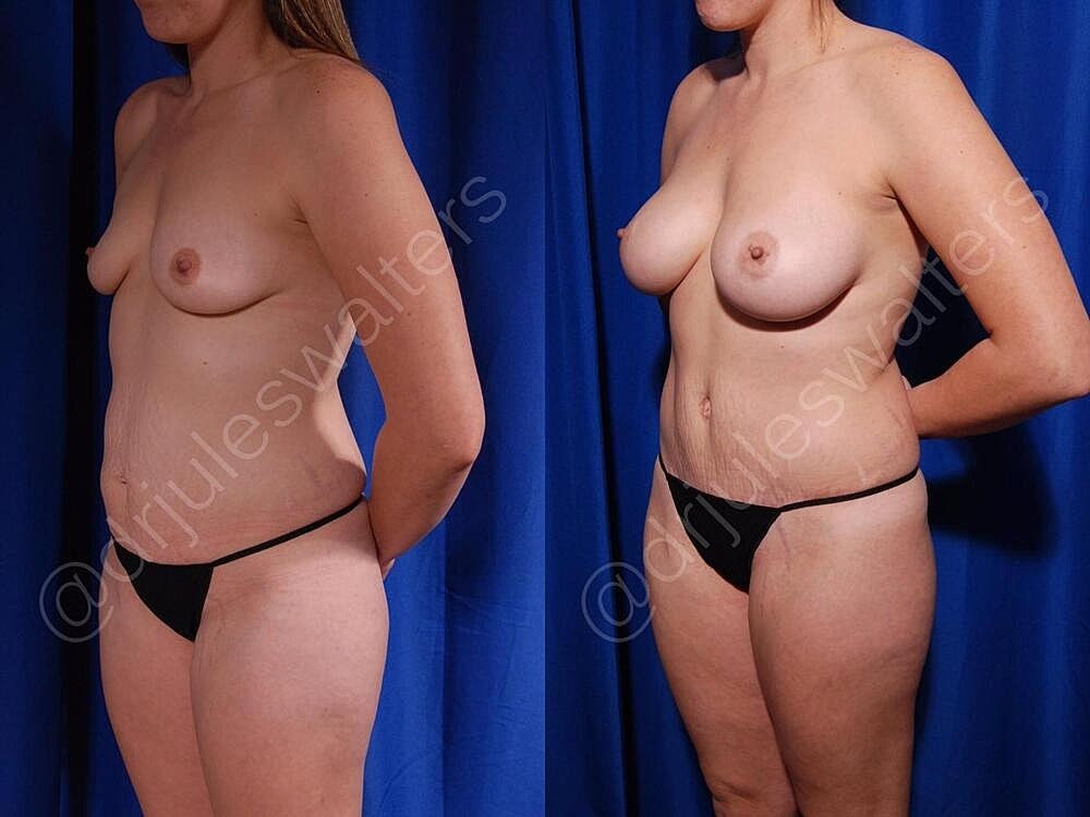 Liposuction Before & After