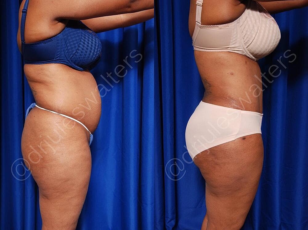 Liposuction Before & After
