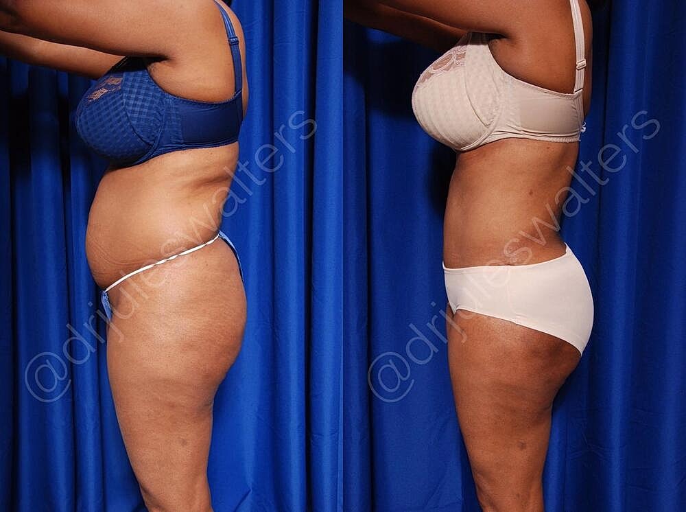 Liposuction Before & After