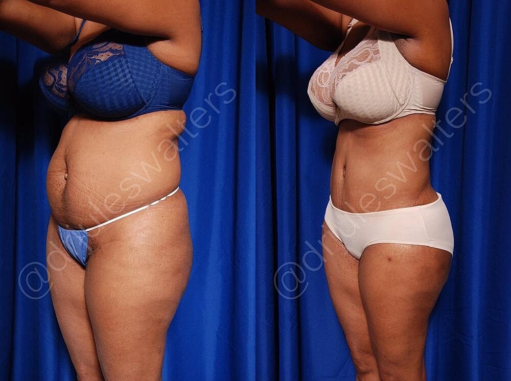 Liposuction Before & After