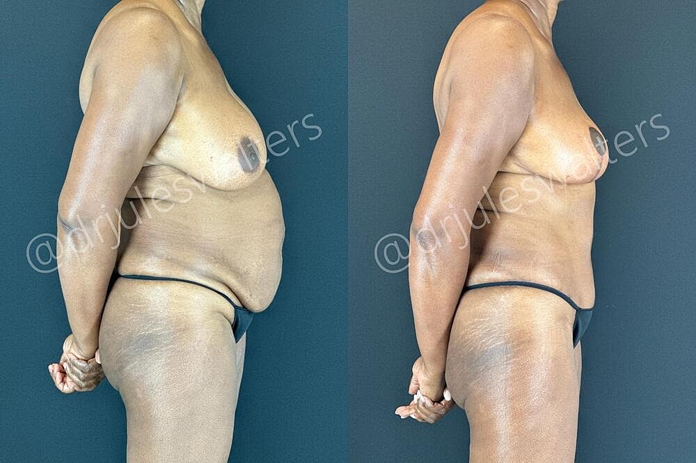 Liposuction Before & After