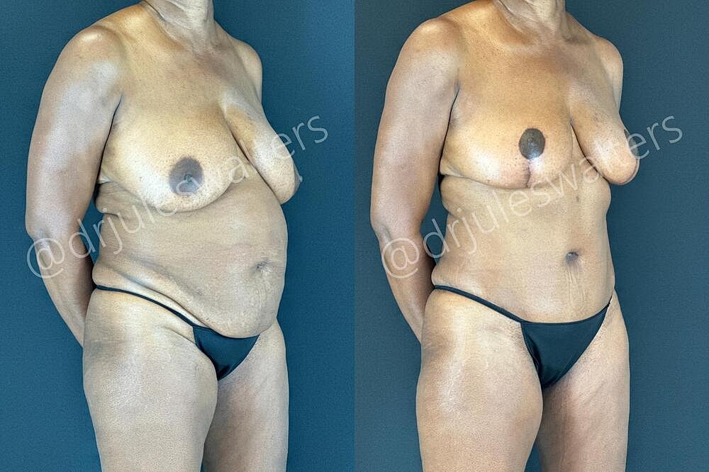 Liposuction Before & After