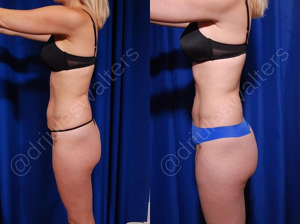 Liposuction Before & After