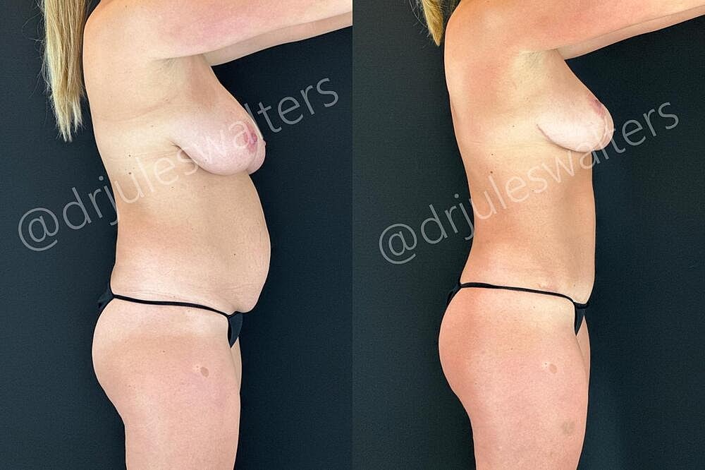 Liposuction Before & After