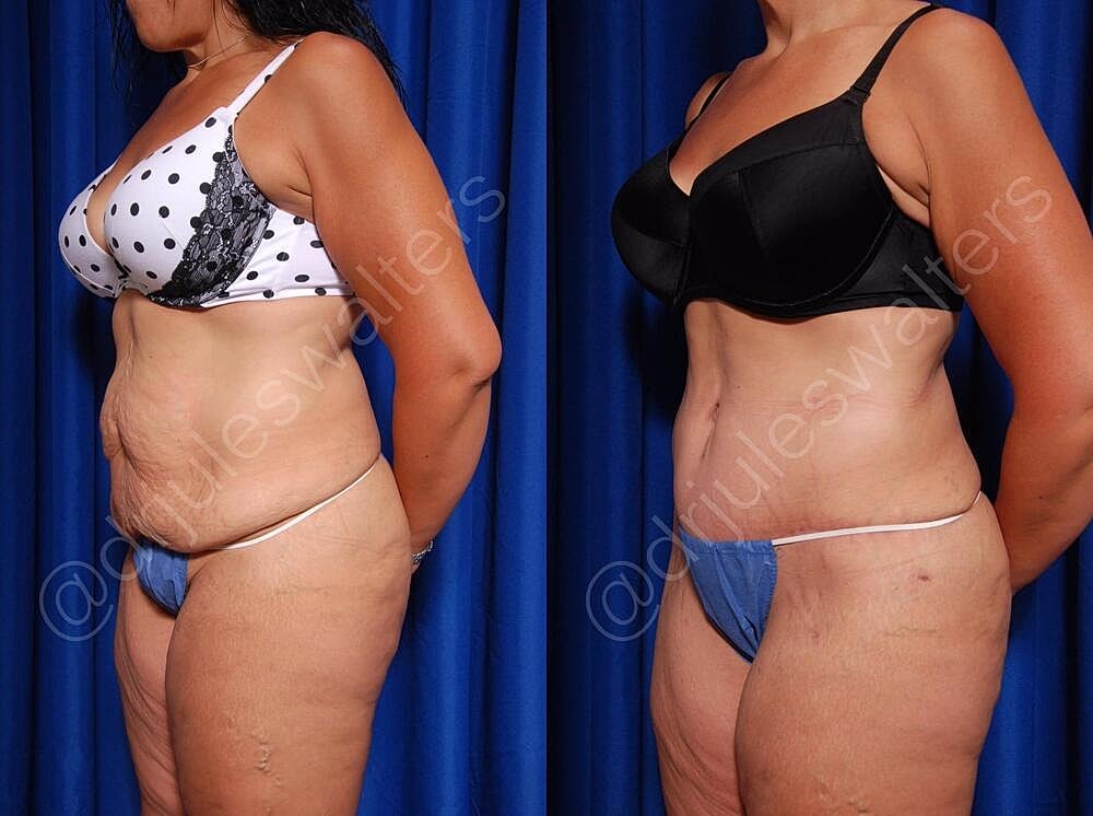 Liposuction Before & After