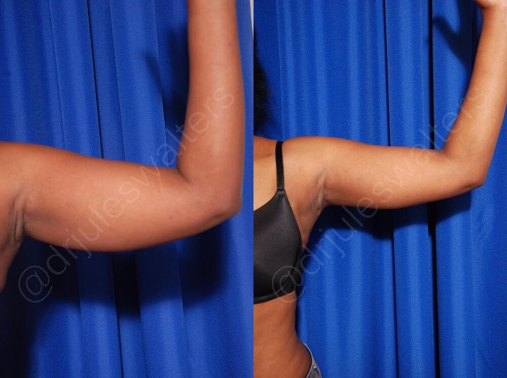 Liposuction Before & After