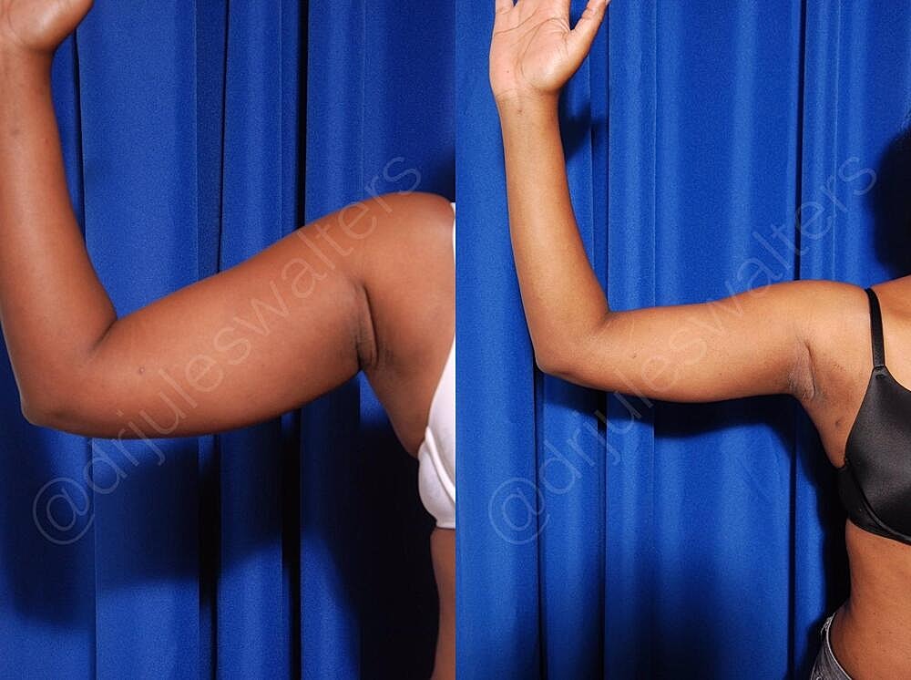 Liposuction Before & After