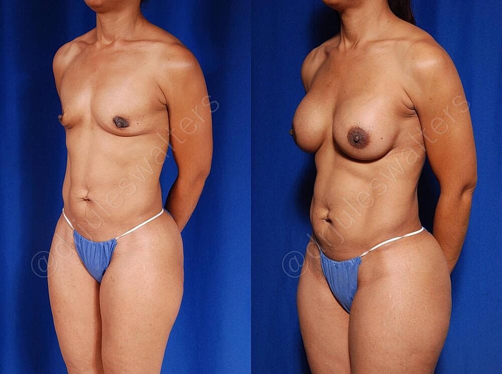 Liposuction Before & After