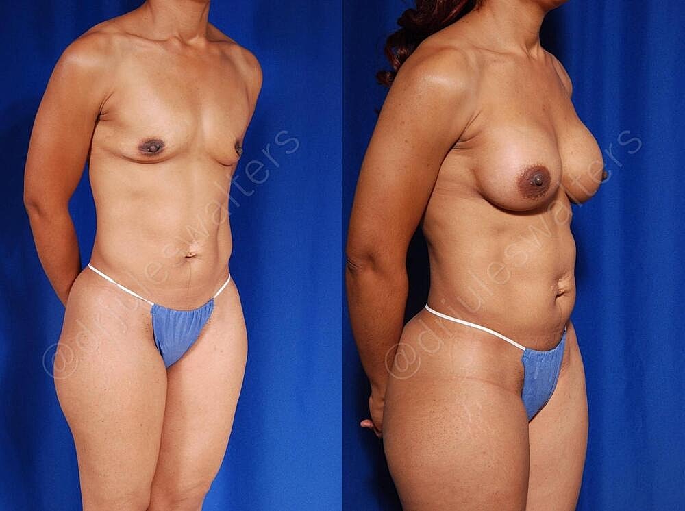 Liposuction Before & After
