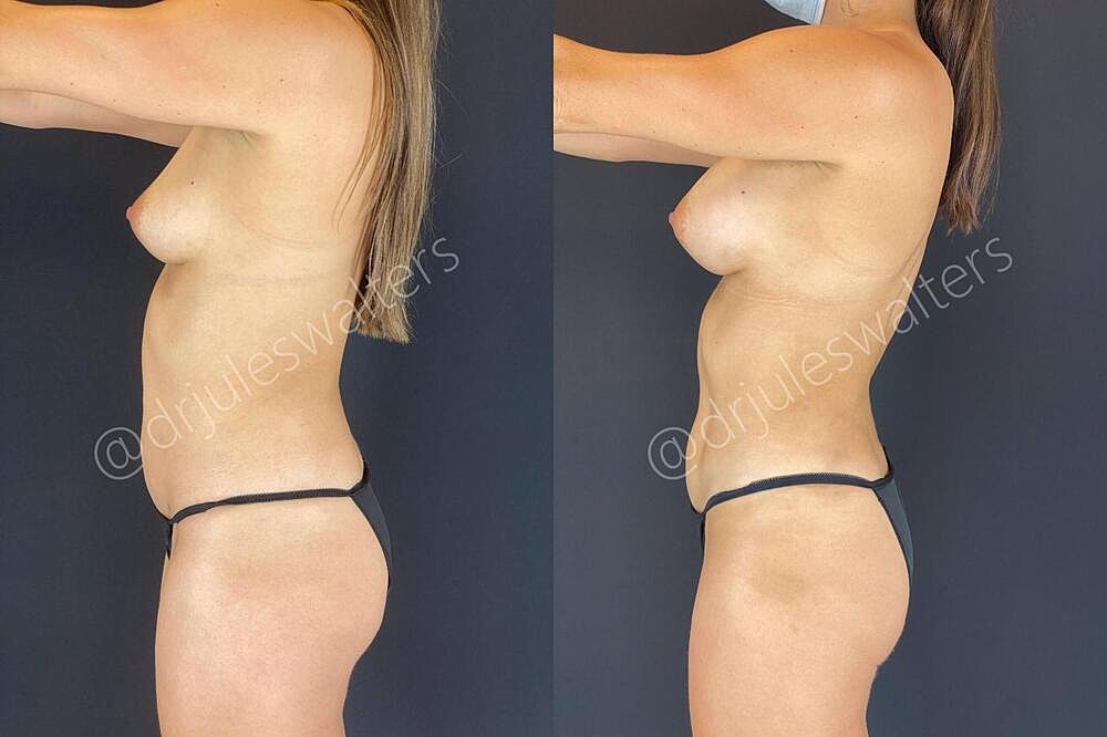 Liposuction Before & After