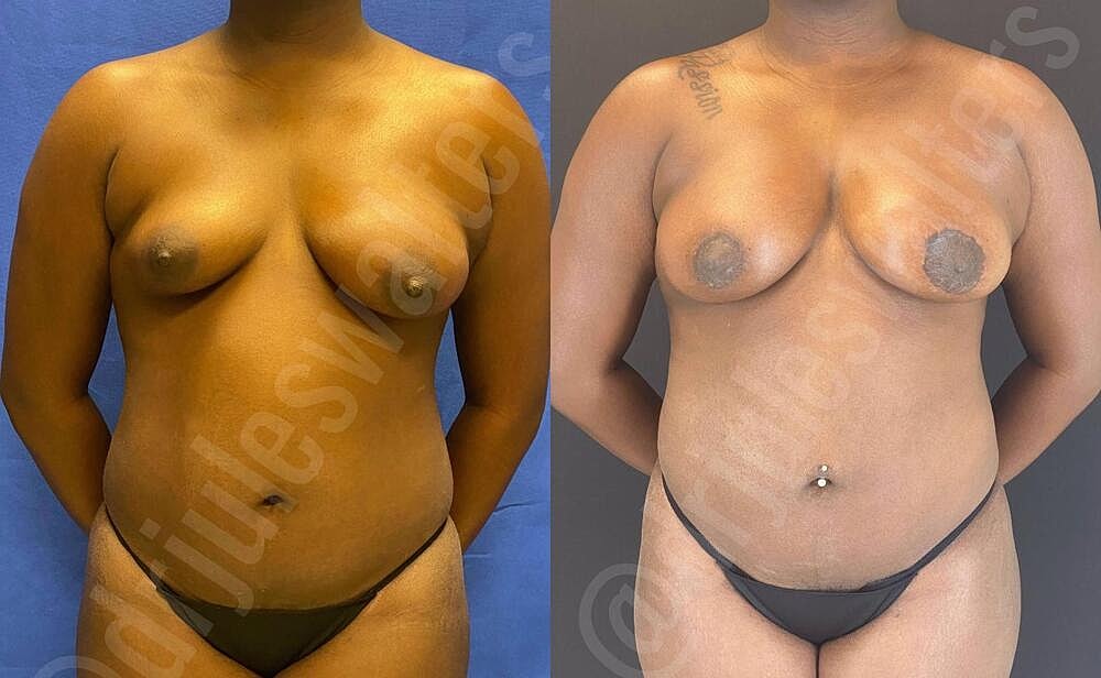 Liposuction Before & After