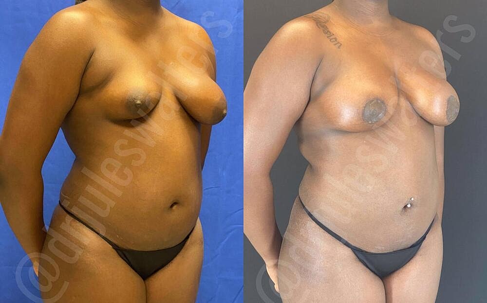 Liposuction Before & After