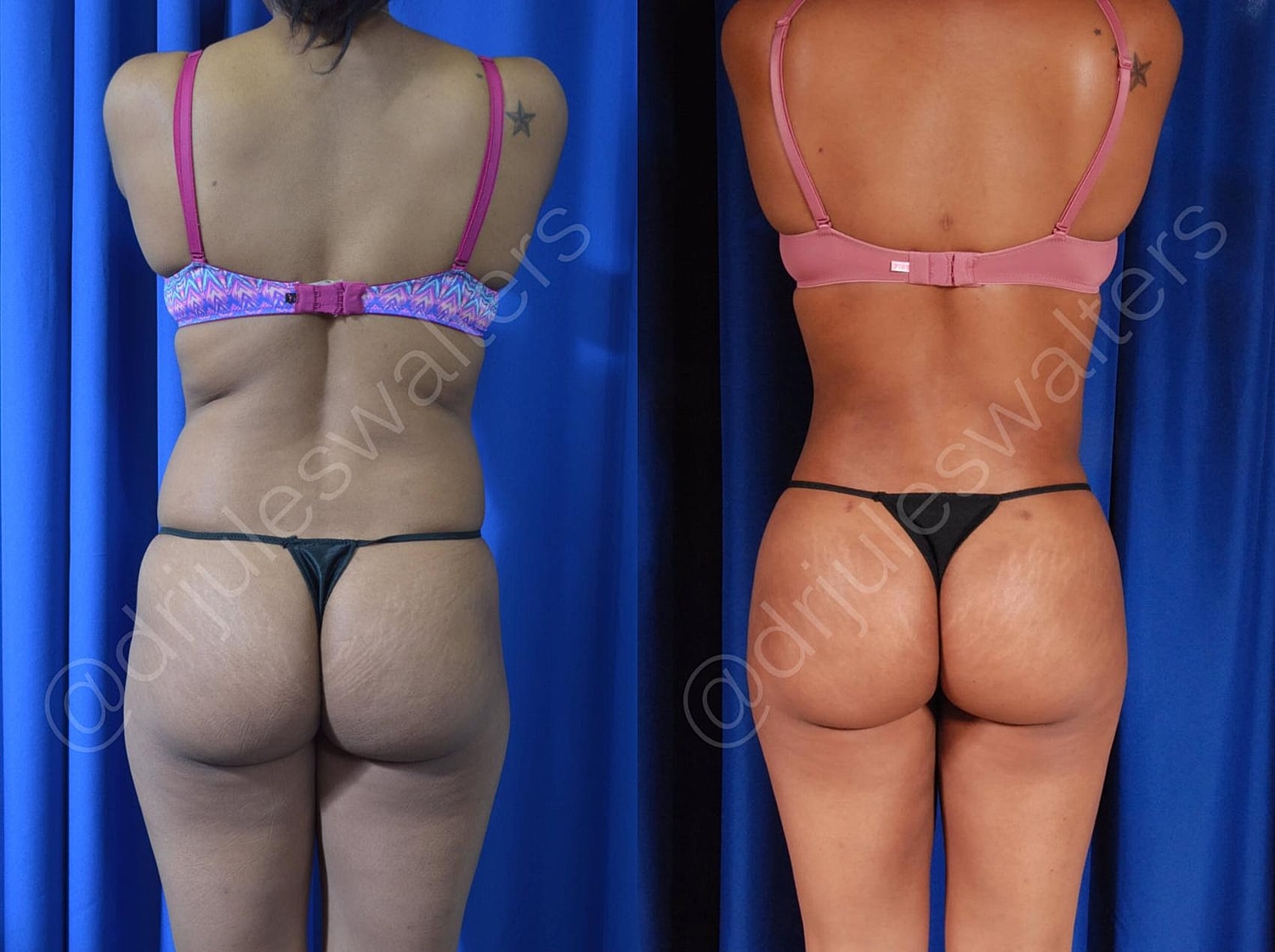 Brazilian Butt Lift Before & After