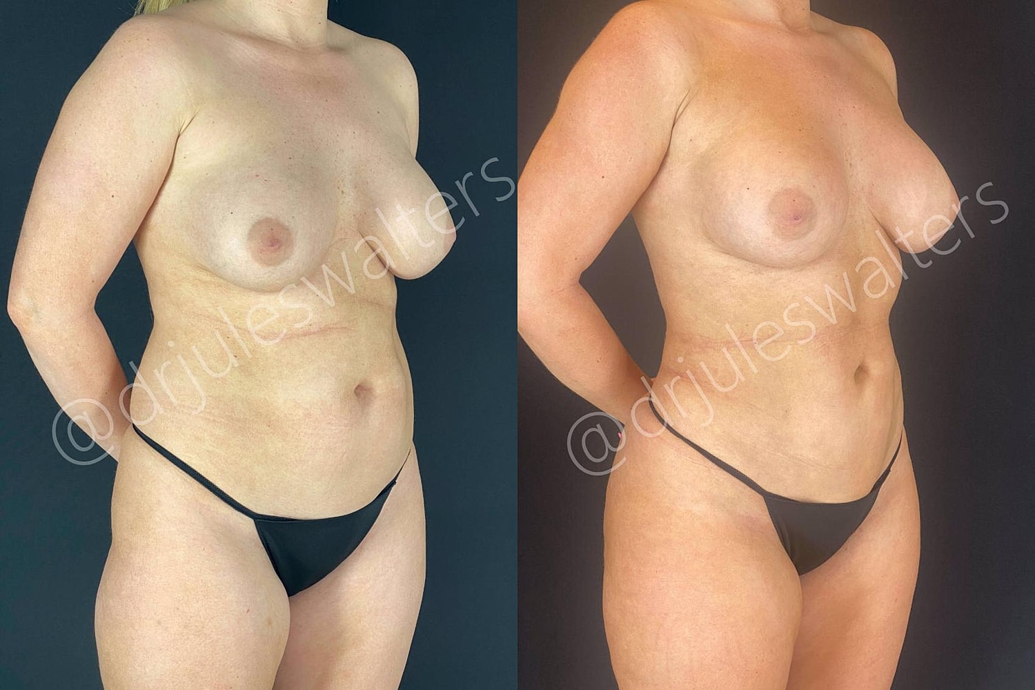 Brazilian Butt Lift Before & After