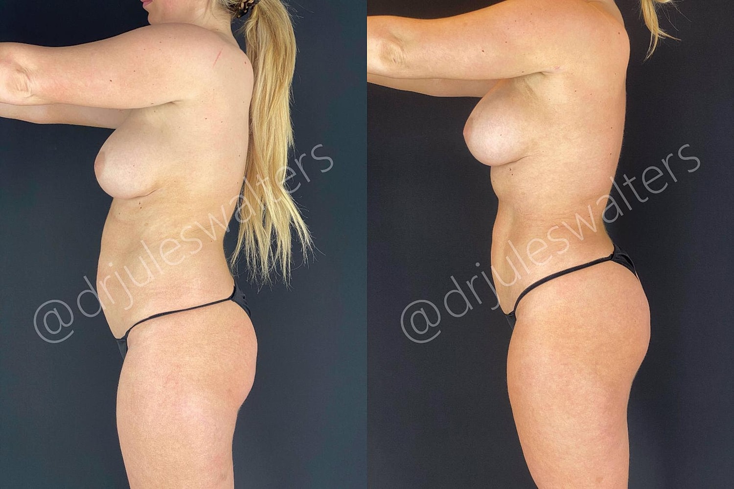 Brazilian Butt Lift Before & After