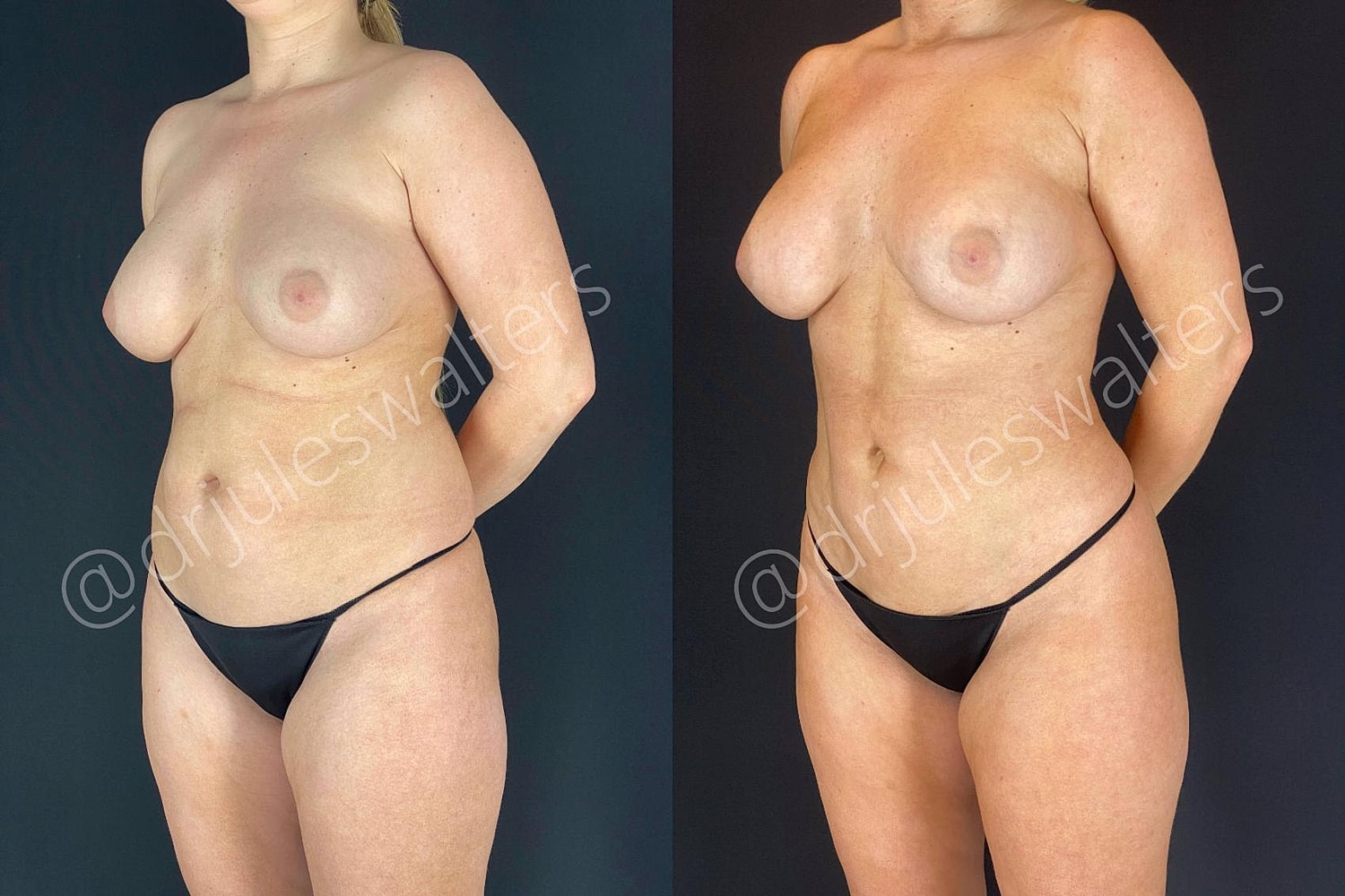 Brazilian Butt Lift Before & After