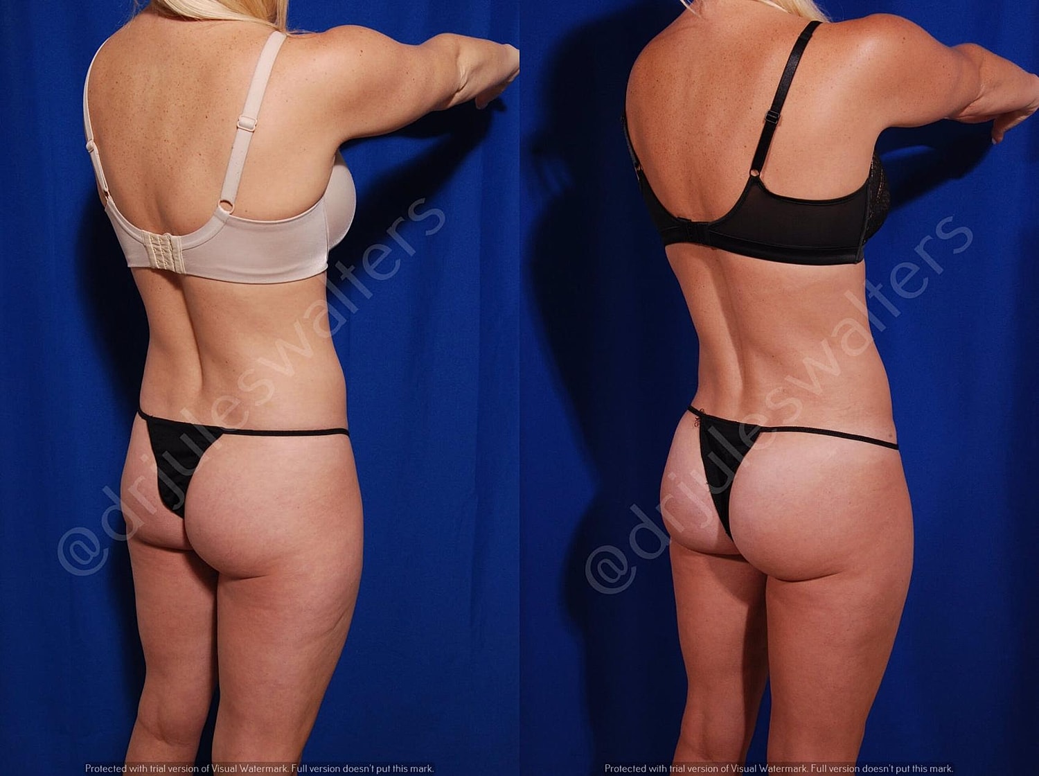 Brazilian Butt Lift Before & After