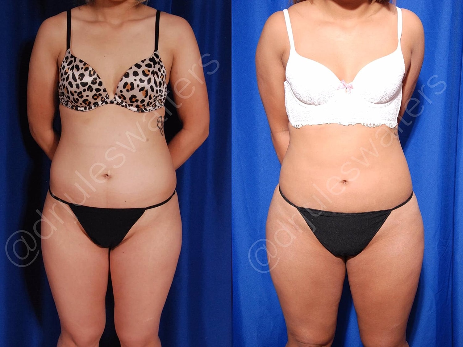 Brazilian Butt Lift Before & After