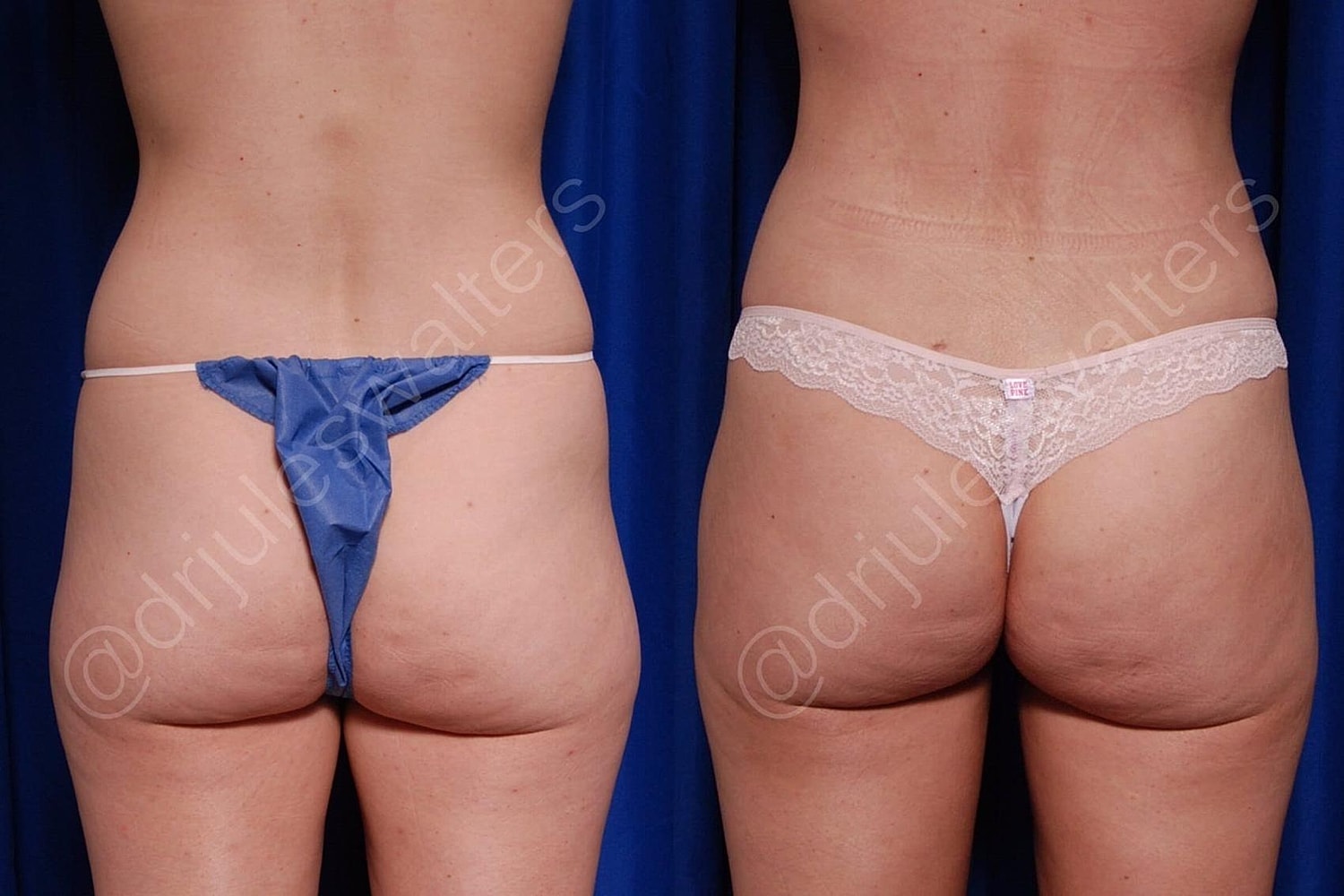 Brazilian Butt Lift Before & After