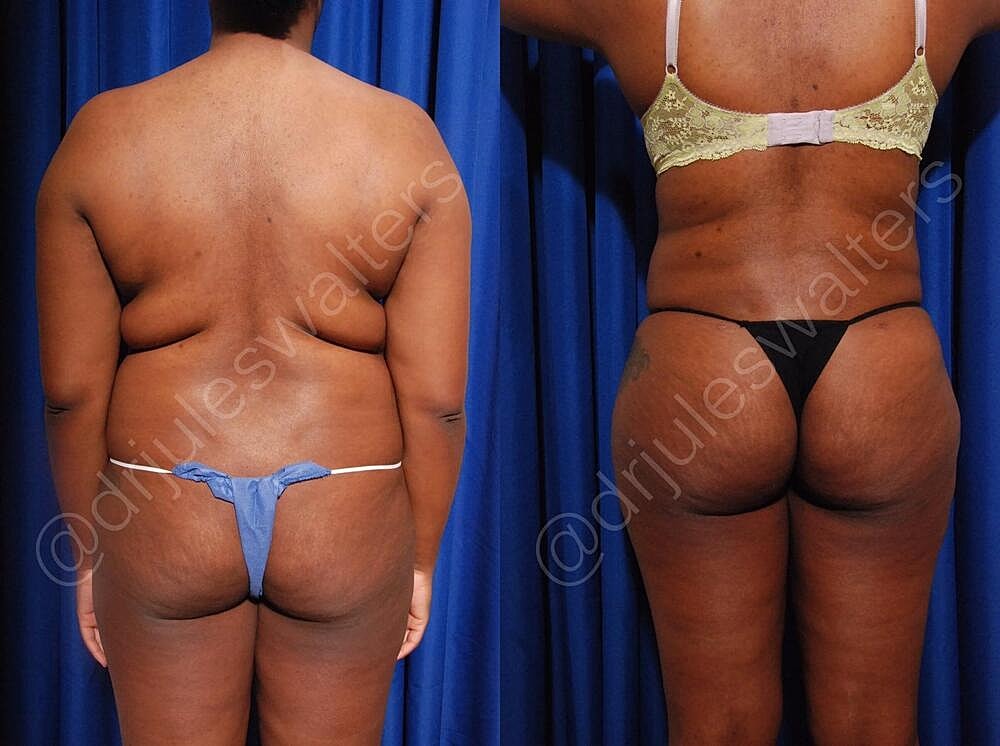 Brazilian Butt Lift Before & After