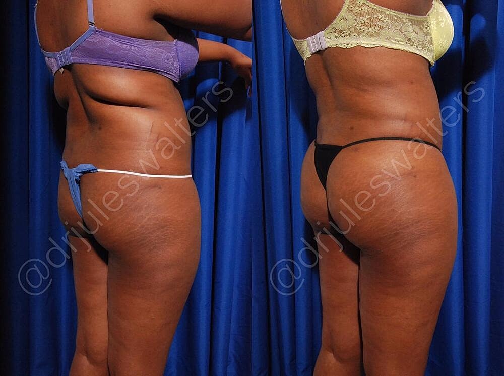 Brazilian Butt Lift Before & After