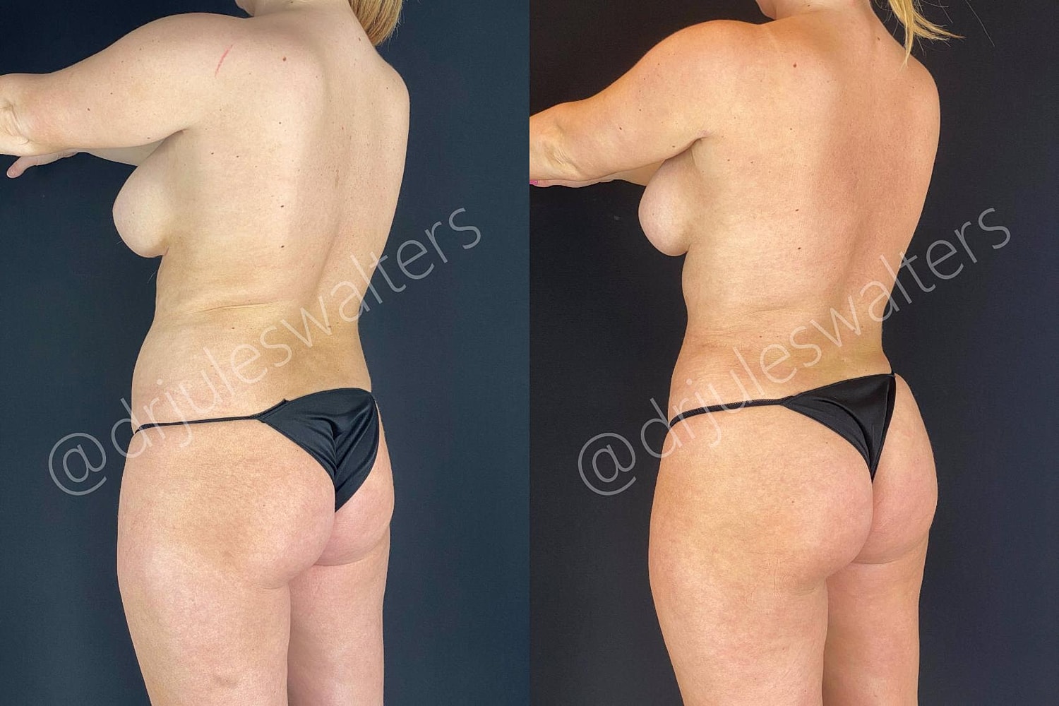 Fat Transfer Before & After