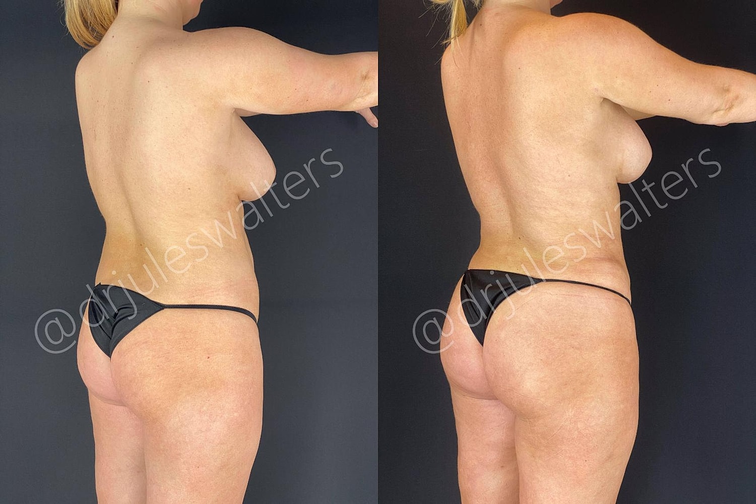 Fat Transfer Before & After