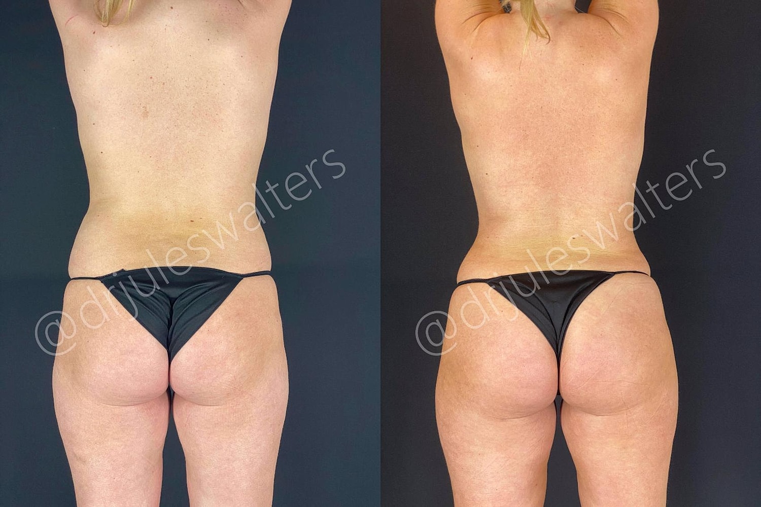 Fat Transfer Before & After