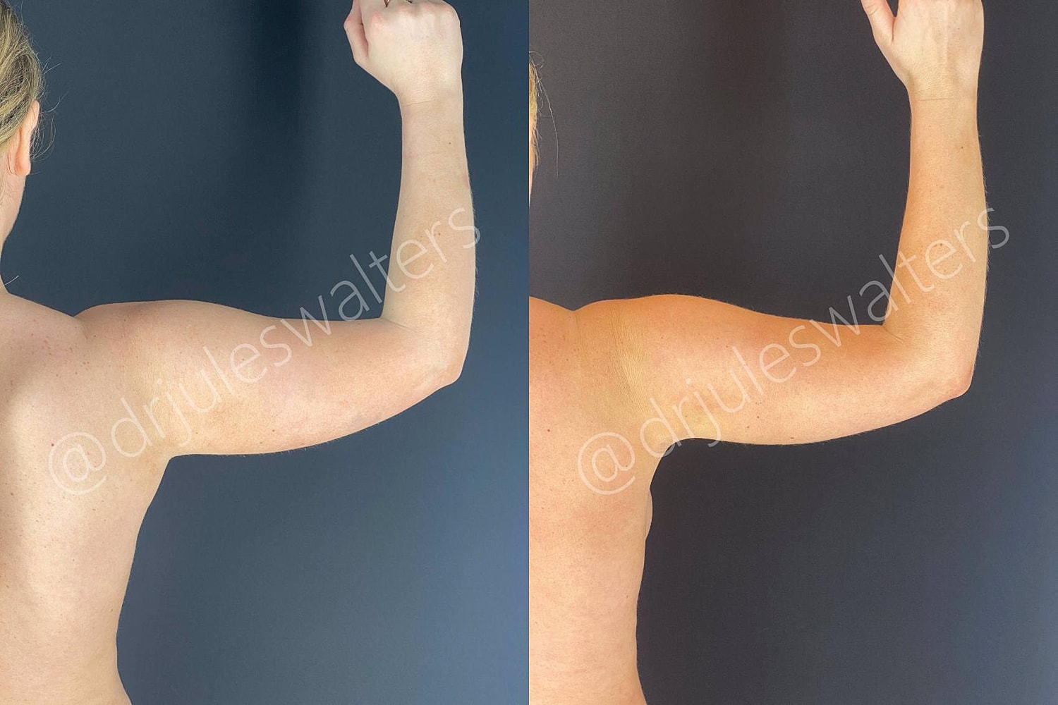 Fat Transfer Before & After