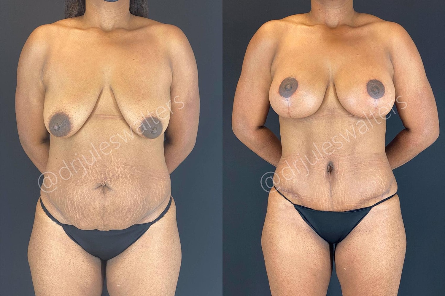 Fat Transfer Before & After