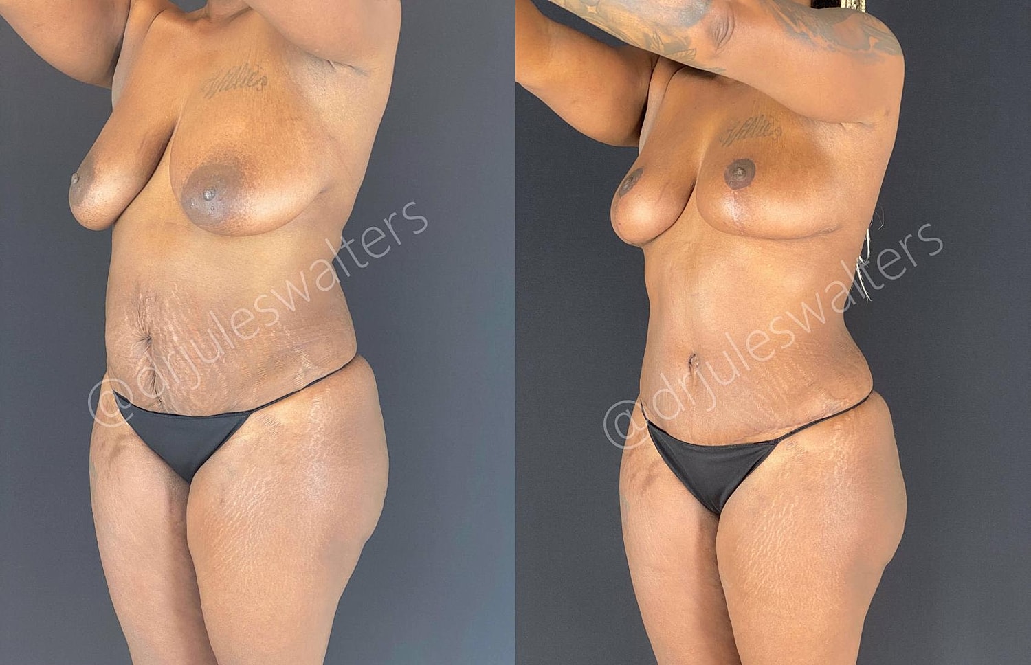 Fat Transfer Before & After
