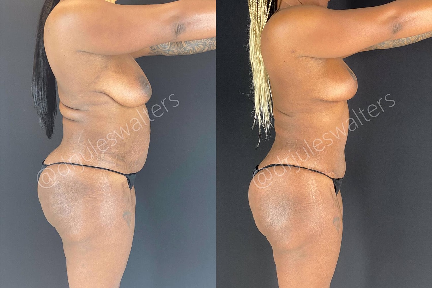 Fat Transfer Before & After