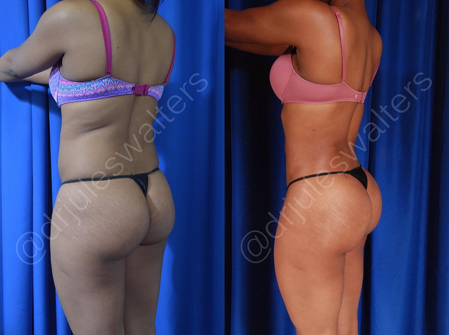Fat Transfer Before & After