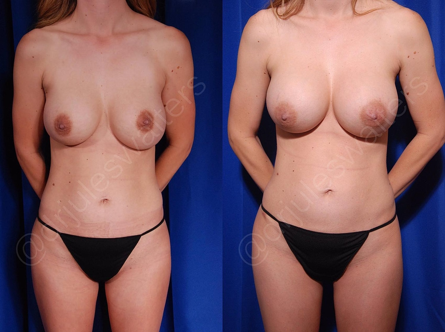 Fat Transfer Before & After