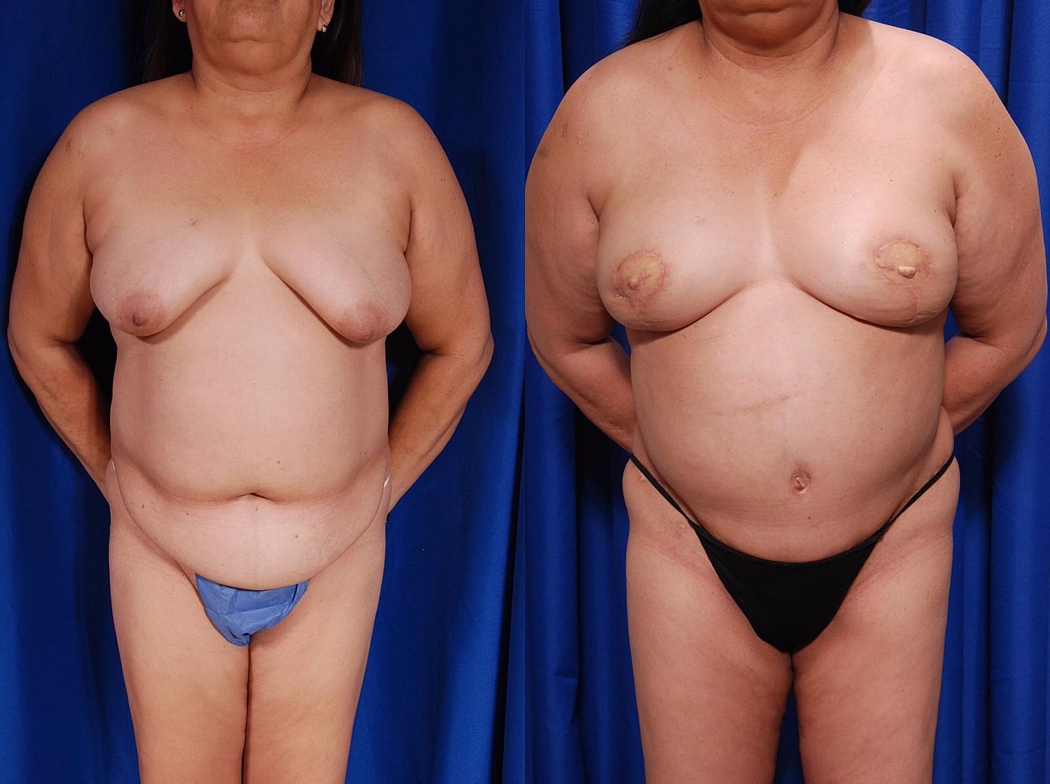 Fat Transfer Before & After