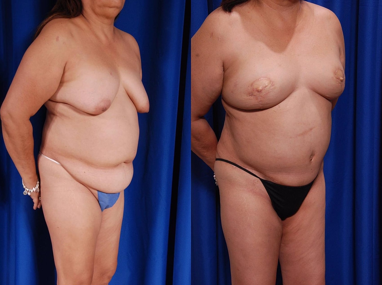 Fat Transfer Before & After