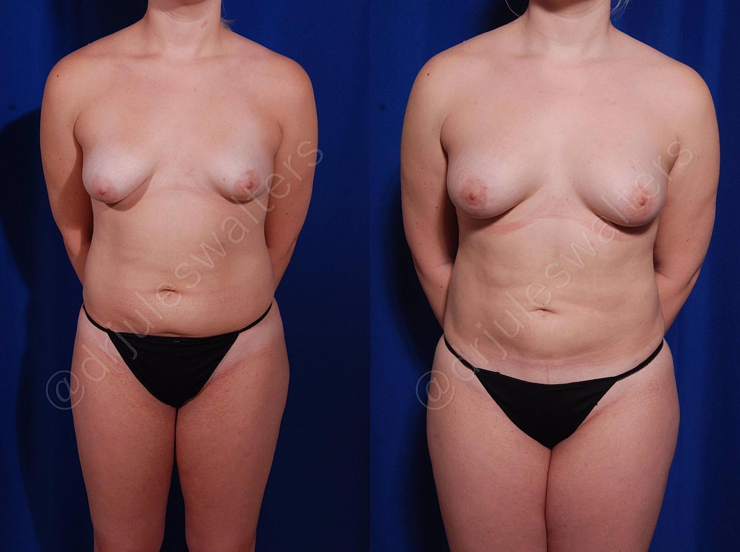 Fat Transfer Before & After