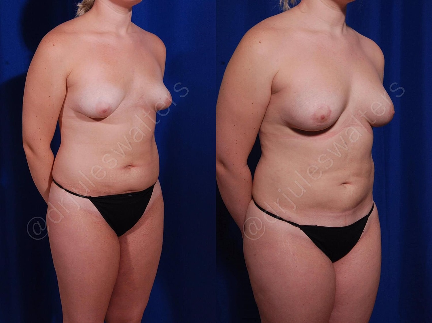 Fat Transfer Before & After