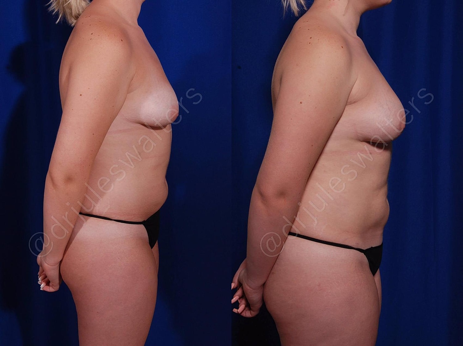 Fat Transfer Before & After