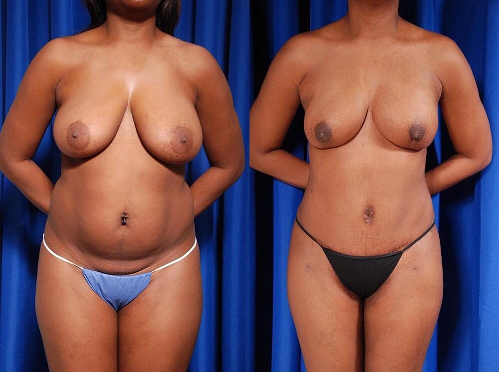 Fat Transfer Before & After