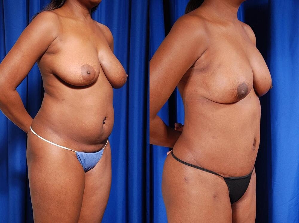 Fat Transfer Before & After