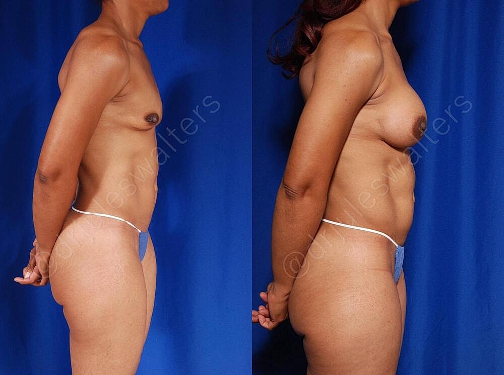 Fat Transfer Before & After